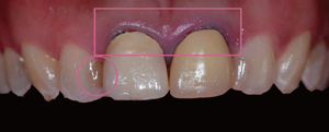 審美歯科症例1-1