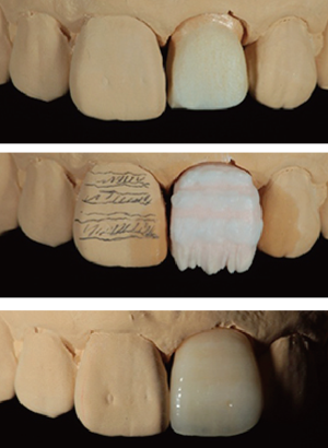 審美歯科症例2-3