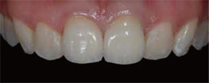 審美歯科症例1-7