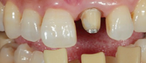審美歯科症例2-1